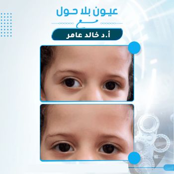 الأطفال-والحول